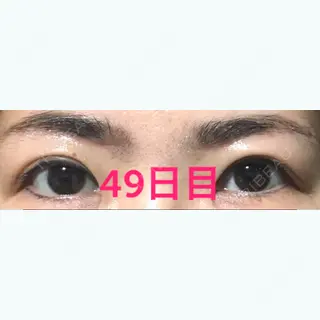49日目の経過画像（1枚目）