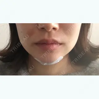 1日目の経過画像（1枚目）