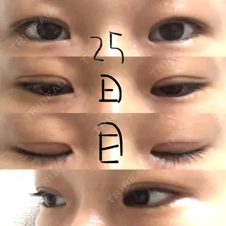 25日目の経過画像（1枚目）