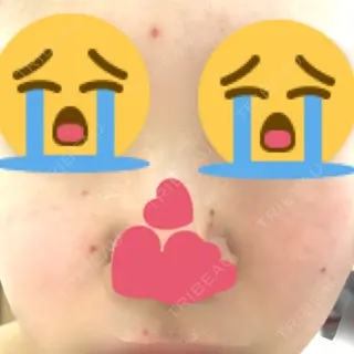 8日目の経過画像（1枚目）