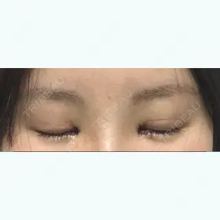 1日目の経過画像（2枚目）