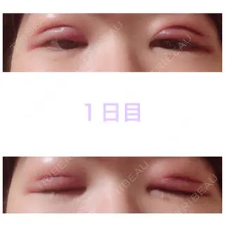 1日目の経過画像（1枚目）