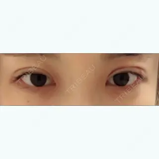 11日目の経過画像（1枚目）
