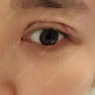 11日目の経過画像（3枚目）