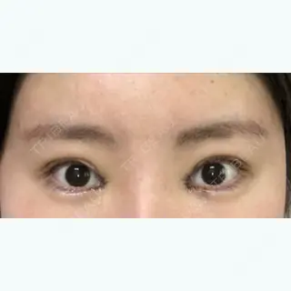 2日目の経過画像（1枚目）