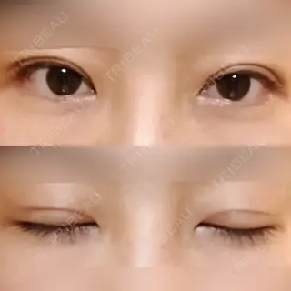 32日目の経過画像（1枚目）