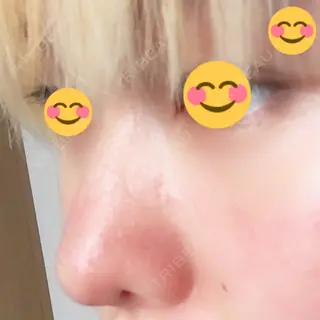 60日目の経過画像（2枚目）