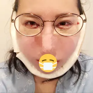 0日目の経過画像（1枚目）