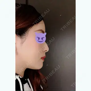 17日目の経過画像（3枚目）