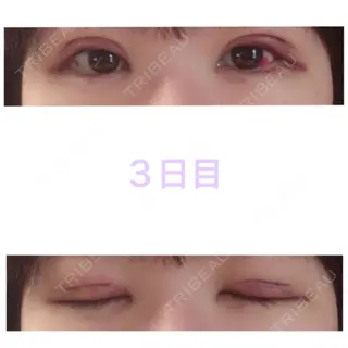 3日目の経過画像（1枚目）
