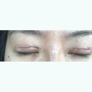 0日目の経過画像（2枚目）