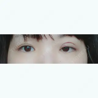 1日目の経過画像（1枚目）