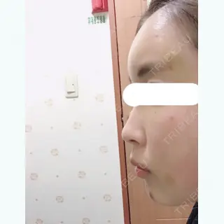 4日目の経過画像（1枚目）