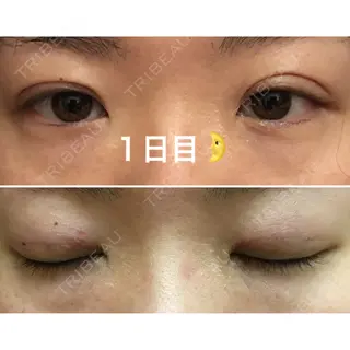 1日目の経過画像（1枚目）