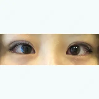 0日目の経過画像（1枚目）