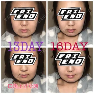 16日目の経過画像（1枚目）