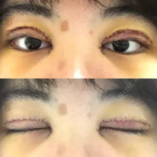 3日目の経過画像（1枚目）