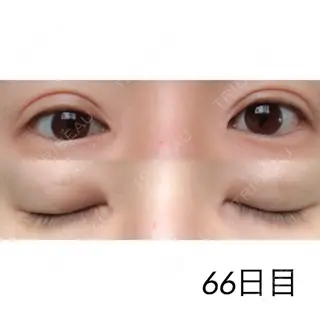 66日目の経過画像（1枚目）