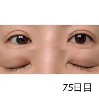 75日目の経過画像（1枚目）