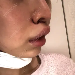 1日目の経過画像（2枚目）