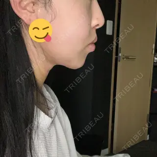 3日目の経過画像（2枚目）