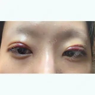 1日目の経過画像（1枚目）