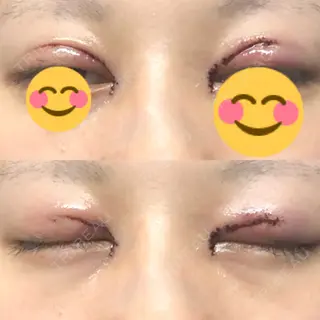 0日目の経過画像（1枚目）