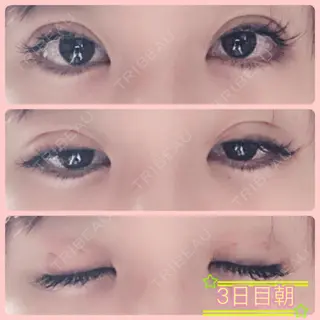 3日目の経過画像（1枚目）