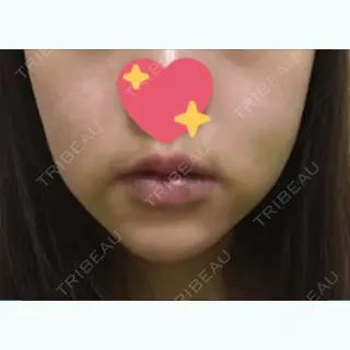 5日目の経過画像（1枚目）