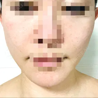 0日目の経過画像（1枚目）