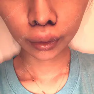 2日目の経過画像（1枚目）
