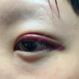 2日目の経過画像（3枚目）