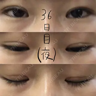36日目の経過画像（1枚目）