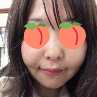 13日目の経過画像（1枚目）
