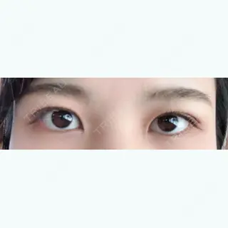 75日目の経過画像（1枚目）