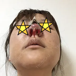 0日目の経過画像（2枚目）