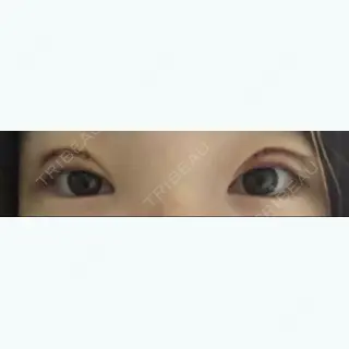 3日目の経過画像（1枚目）