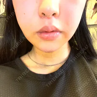 4日目の経過画像（1枚目）