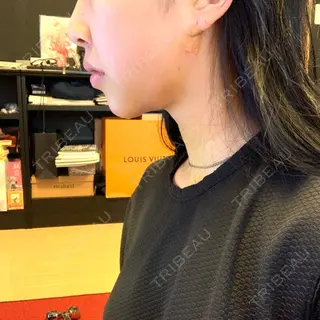 4日目の経過画像（2枚目）