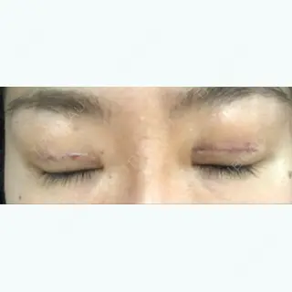 4日目の経過画像（3枚目）