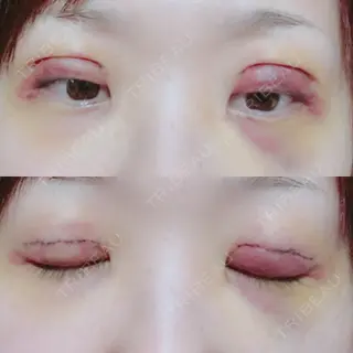 3日目の経過画像（1枚目）