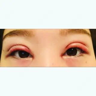1日目の経過画像（1枚目）