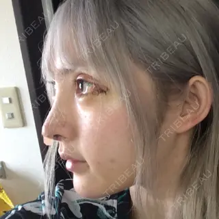 6日目の経過画像（1枚目）