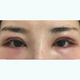 2日目の経過画像（1枚目）