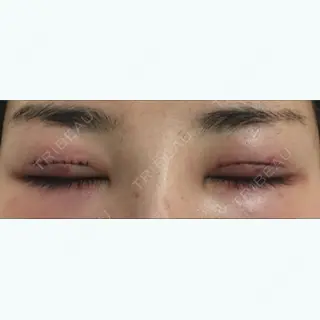 2日目の経過画像（2枚目）