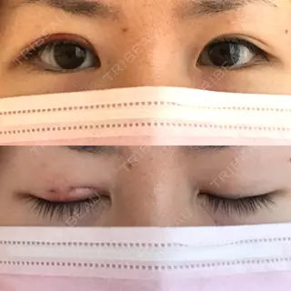 2日目の経過画像（1枚目）