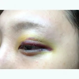 3日目の経過画像（2枚目）