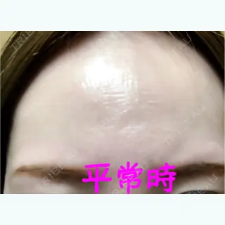 5日目の経過画像（2枚目）