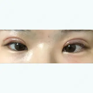 27日目の経過画像（1枚目）