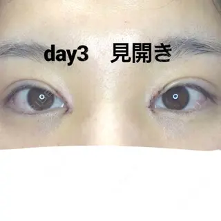 3日目の経過画像（2枚目）